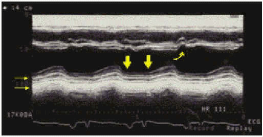 Constriccion y ecocardiograma modo con movimiento anormal del septum