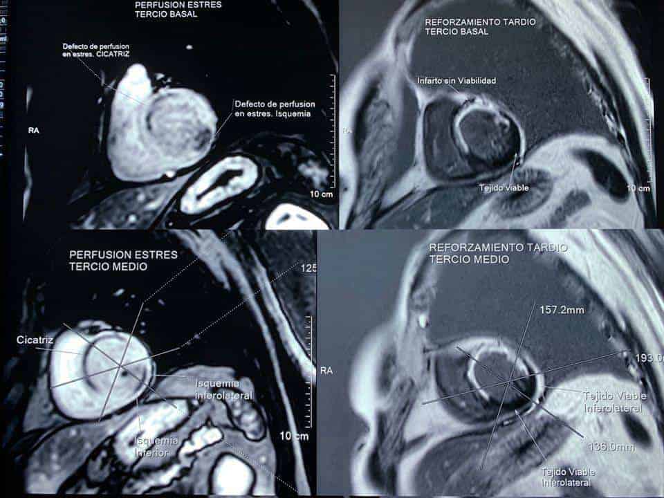Resonancia Magnética Cardiaca Guadalajara - Cardiologos Guadalajara