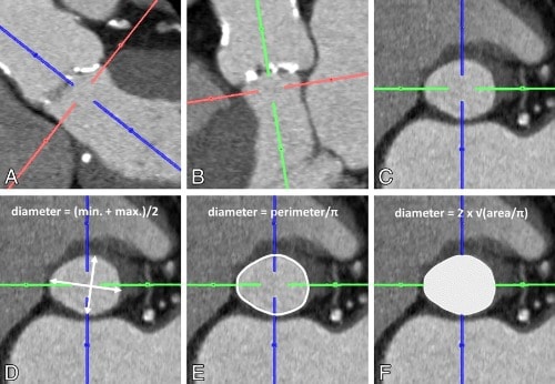 Tomografia Cardiaca y medición del anillo aortico