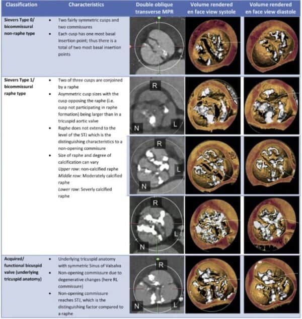 calcificacion de aorta bivalva sievers