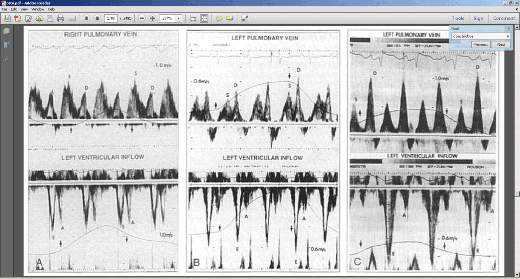 Fisiopatologia constrictiva y restrictiva analisis Doppler de venas pulmonares