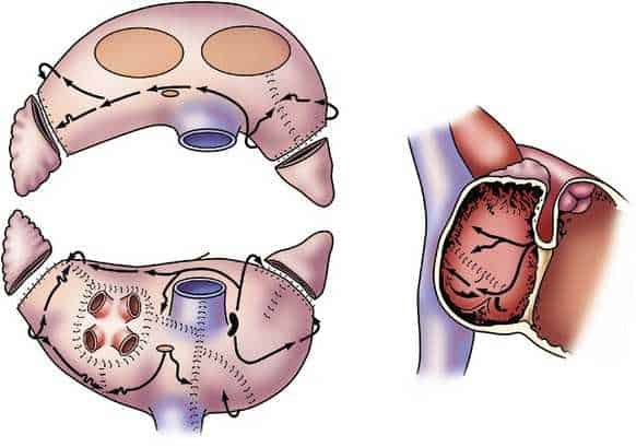 Open Heart Incision Closure Mesh Open Heart Surgery - Mayo Clinic Care Network