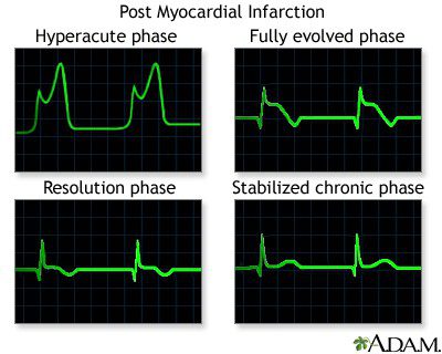 Electrocardiograma en la Prueba de Esfuerzo