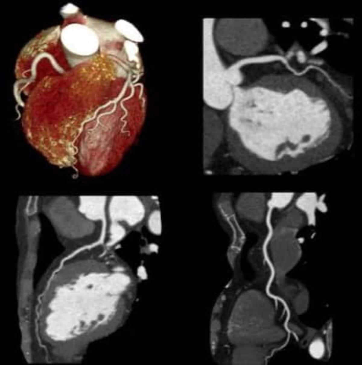 arterias corornarias y tomografia cardiaca